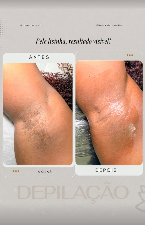 Montagem original de antes e depois: Depilação de axilas