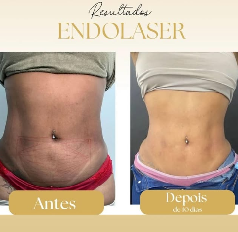 Montagem original de antes e depois: Endolaser