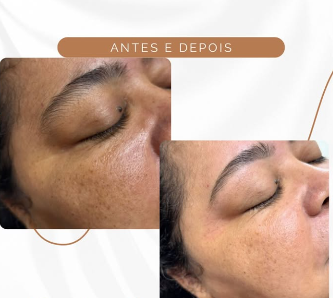 Montagem original de antes e depois: Cuidados faciais