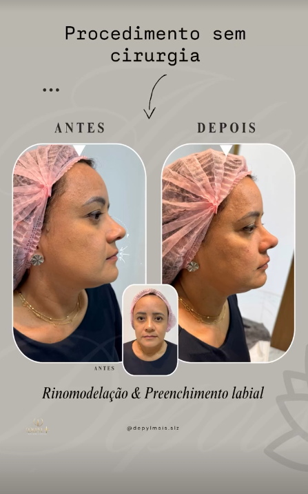 Montagem original de antes e depois: Rinomodelação e preenchimento labial